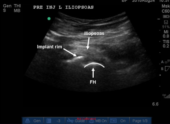 iliopsoas bursitis ultrasound